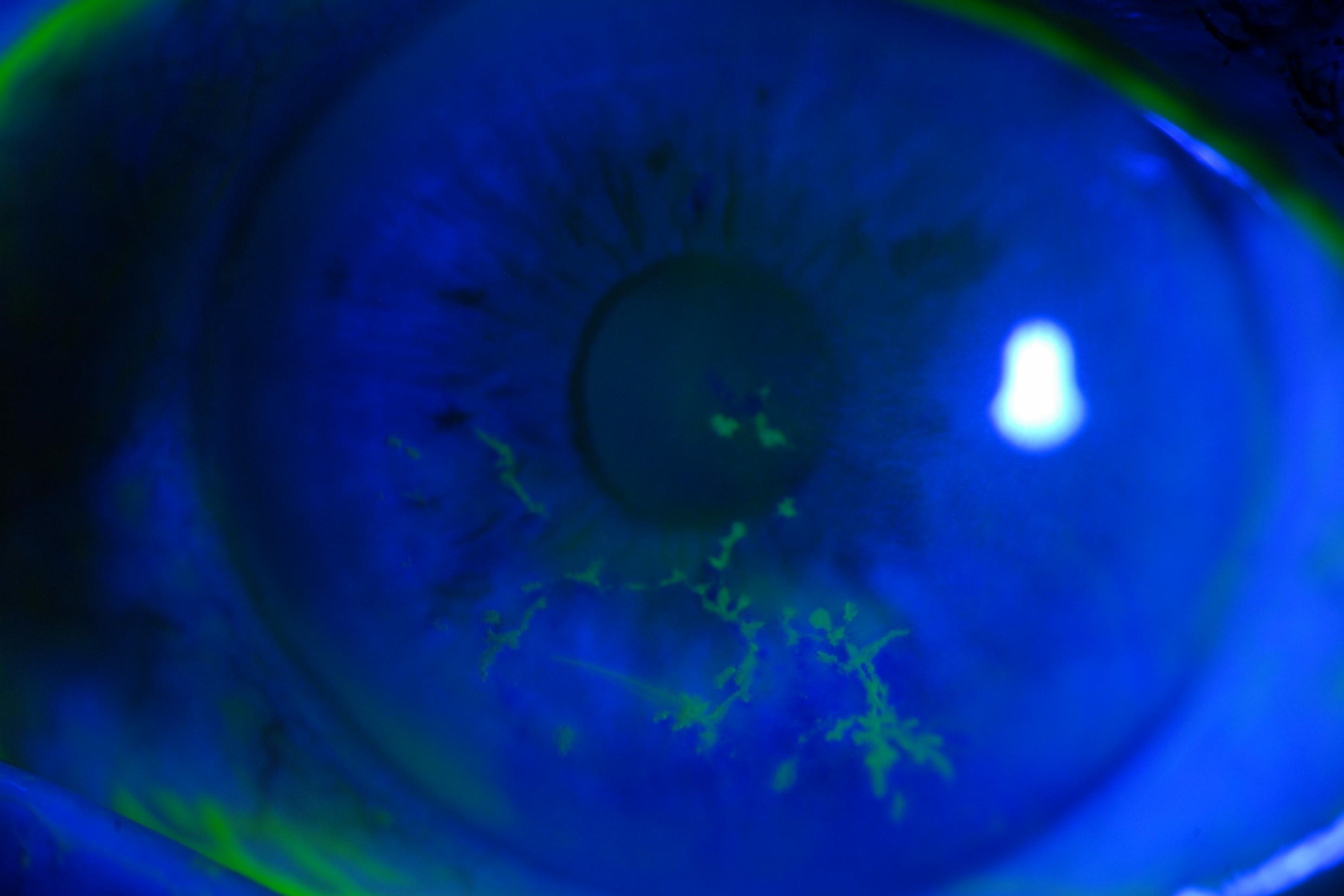 HZOrelated disease postcataract eyeonoptics