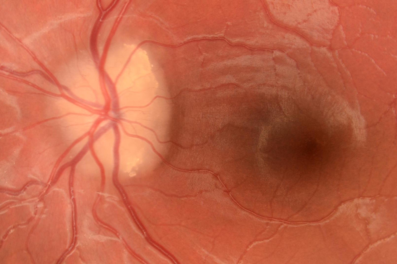 Optic disc drusen and pseudopapilloedema eyeonoptics