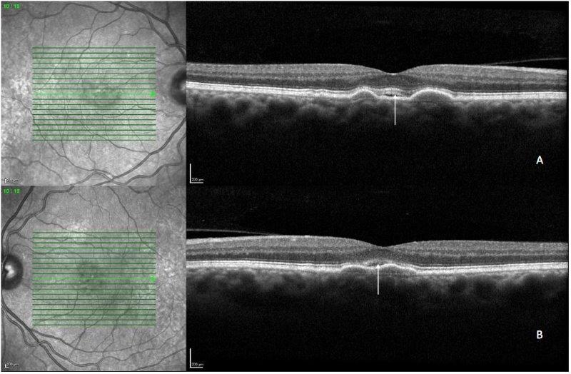 CASE STUDY: non-neovascular subretinal fluid in AMD