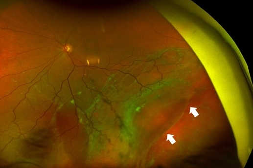 Atopic dermatitis and retinal detachment