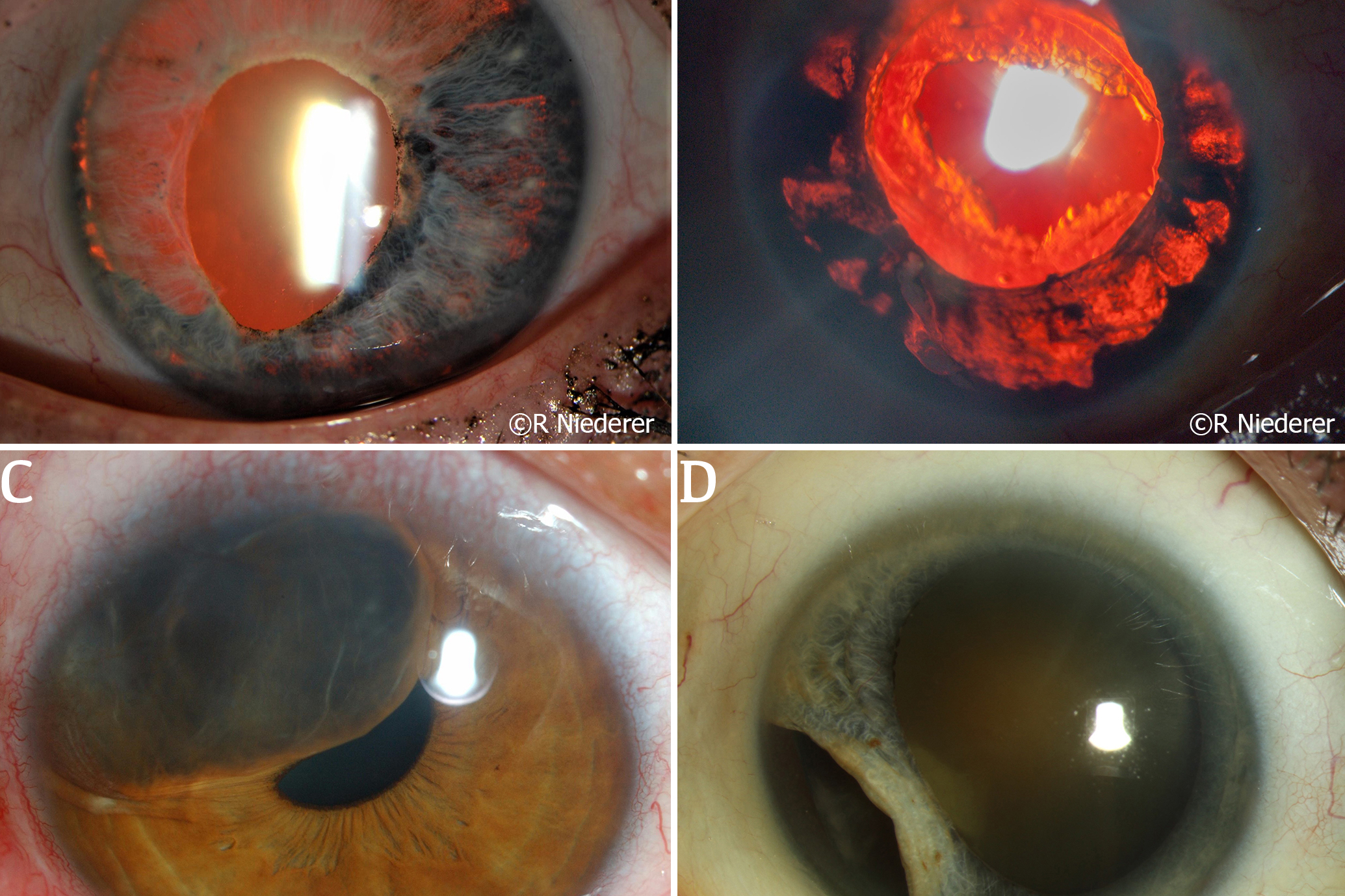 The iris in health and disease, part II: Iris transillumination defects and rubeosis iridis