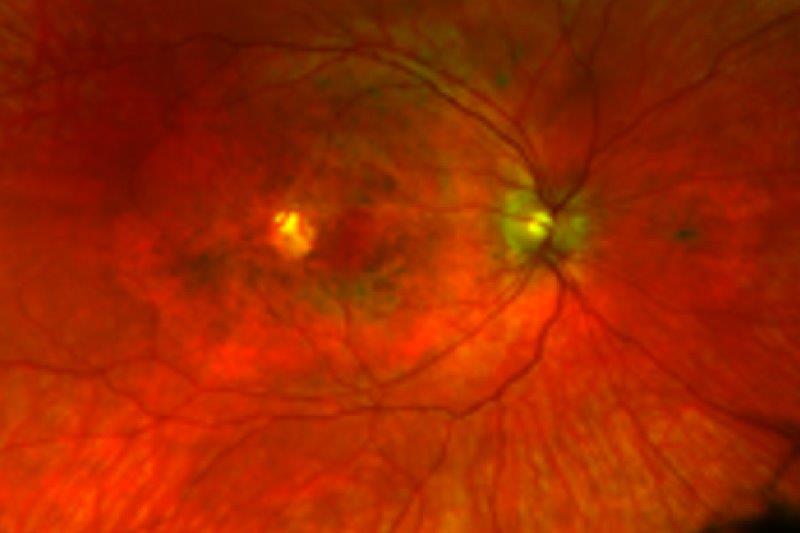 New macular dystrophy discovered