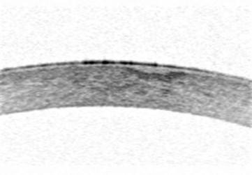 Fig 2. Anterior segment OCT image of opacity
