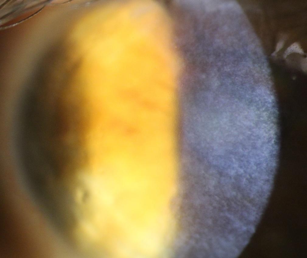 Fig 4. Slit lamp photo showing widespread corneal opacities.