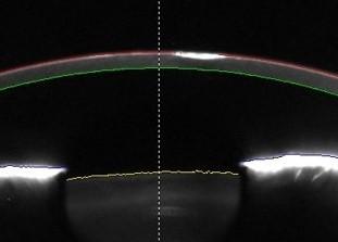 Fig 1. Scheimpflug image showing corneal opacity