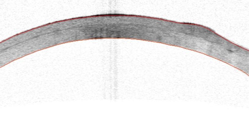 Fig 3. Postoperative OCT of cornea showing lamellar graft