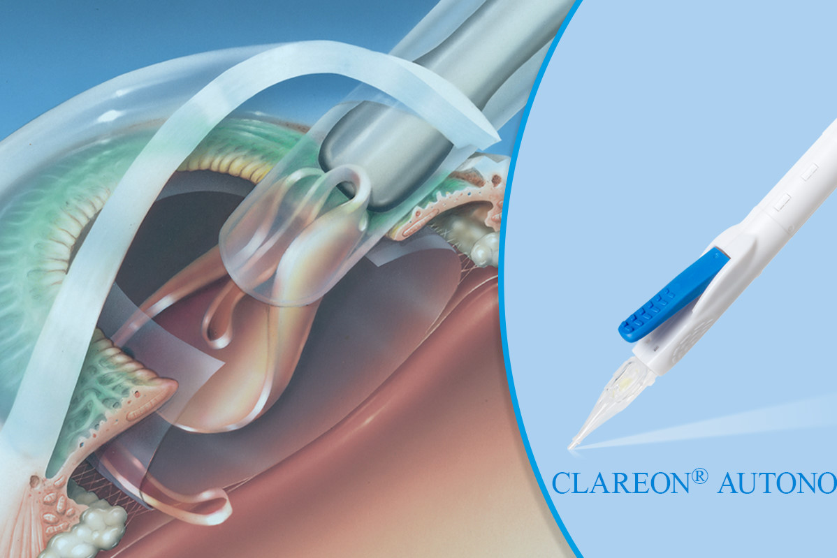 Clareon иол. Иол vivity alcon. Иол clareon cnа0t0 (сша). Иол alcon. Иол alcon acrysof.