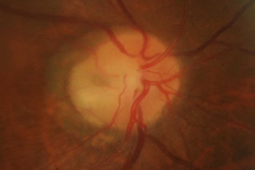Optic disc pit with maculopathy nzoptics