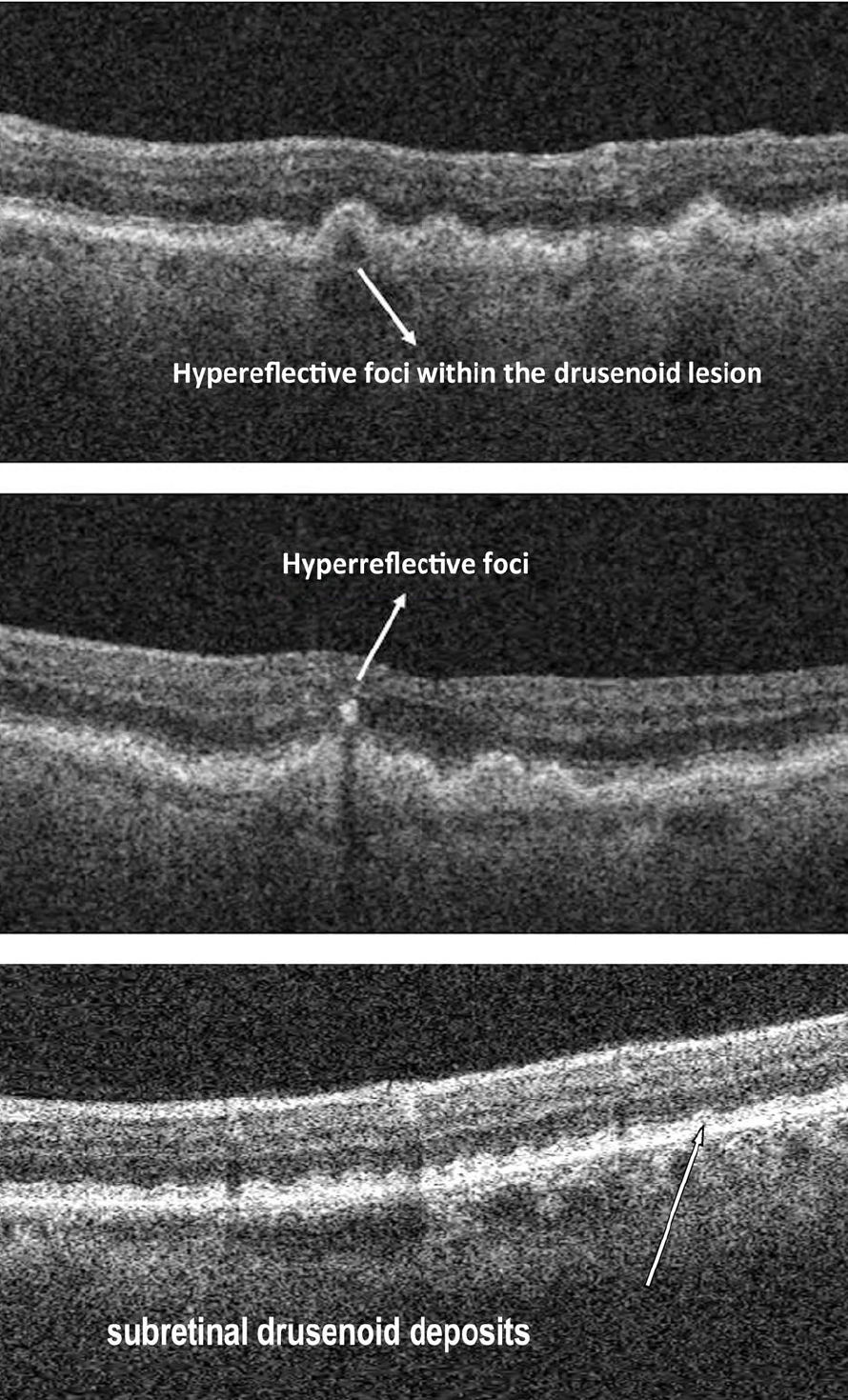 CASE STUDY: Optimising outcome in non-exudative AMD