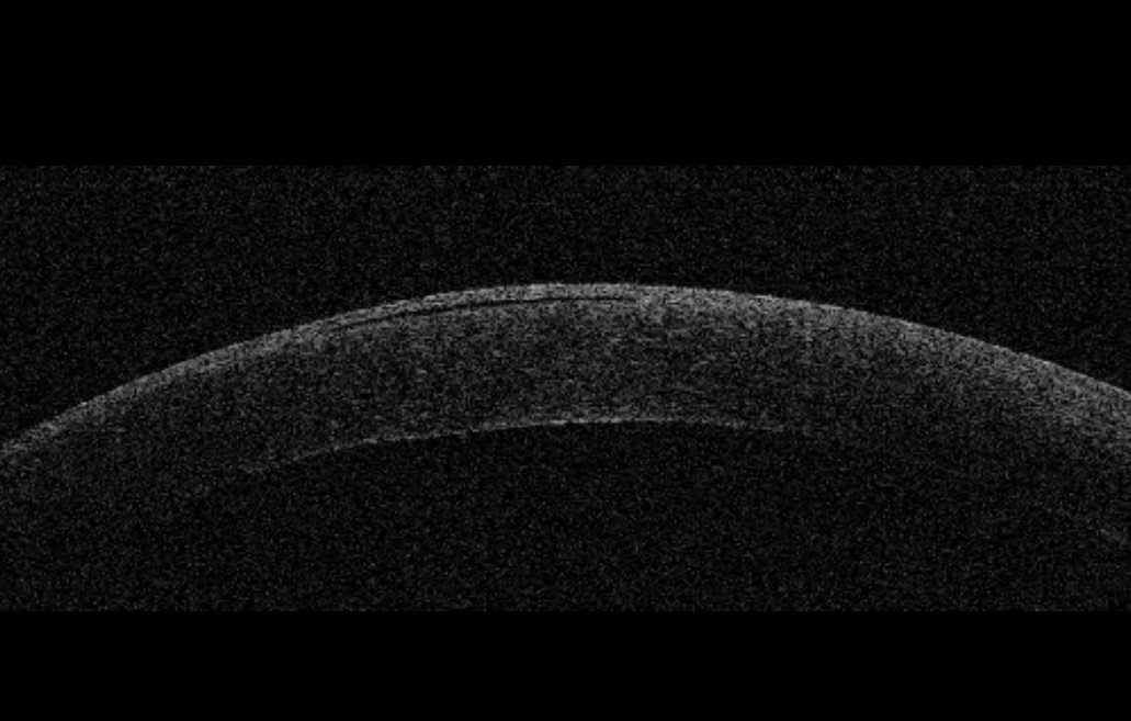 Case study There was an old lady who fly sprayed her eye…